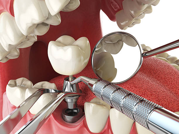 Best Emergency Dentist for Lost Fillings or Crowns in Ellisville, MO